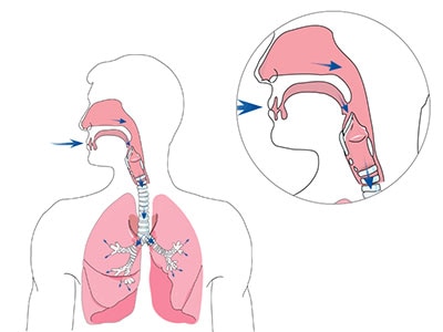 ventilation-non-invasive-à-domicile-respiration-400x300-ResMed Suisse